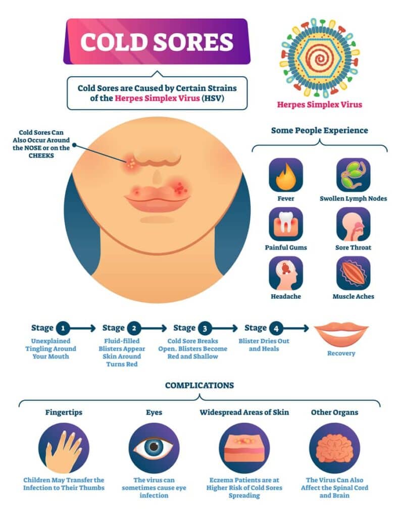 Understanding cold sores is important if you are to find out how to get rid of them fast on your lips